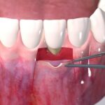 پیوند لثه برای ایمپلنت چیست؟ بررسی کامل سلامت لثه برای موفقیت ایمپلنت