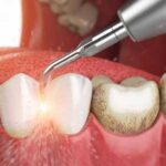 جرم گیری دندان چیست و آیا به مینای دندان آسیب میزند؟