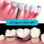 تفاوت ایمپلنت و بریج دندان؛ کدام روش برای شما مناسبتر است؟